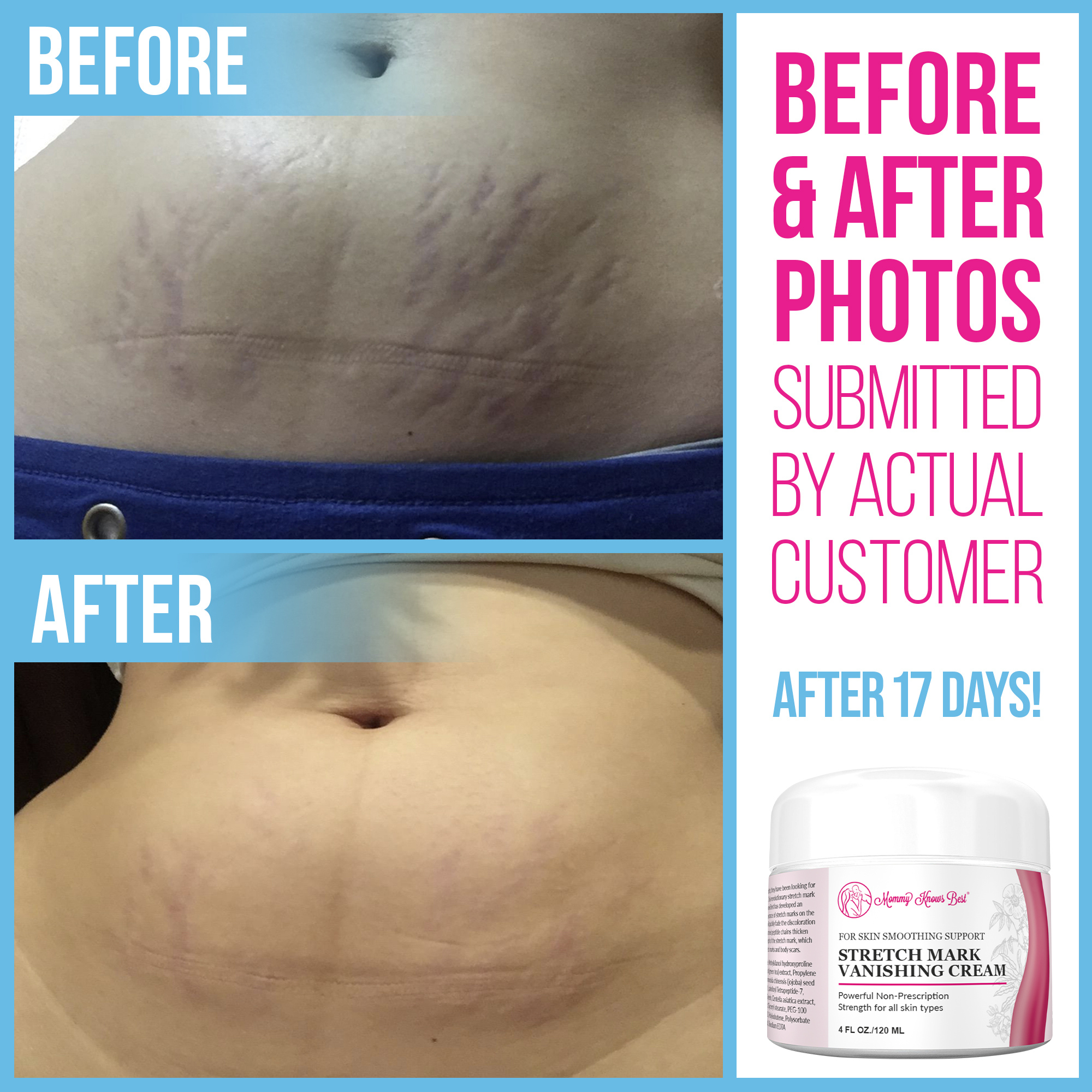 Stretch Mark Vanishing Cream - 4oz – Mommy Knows Best